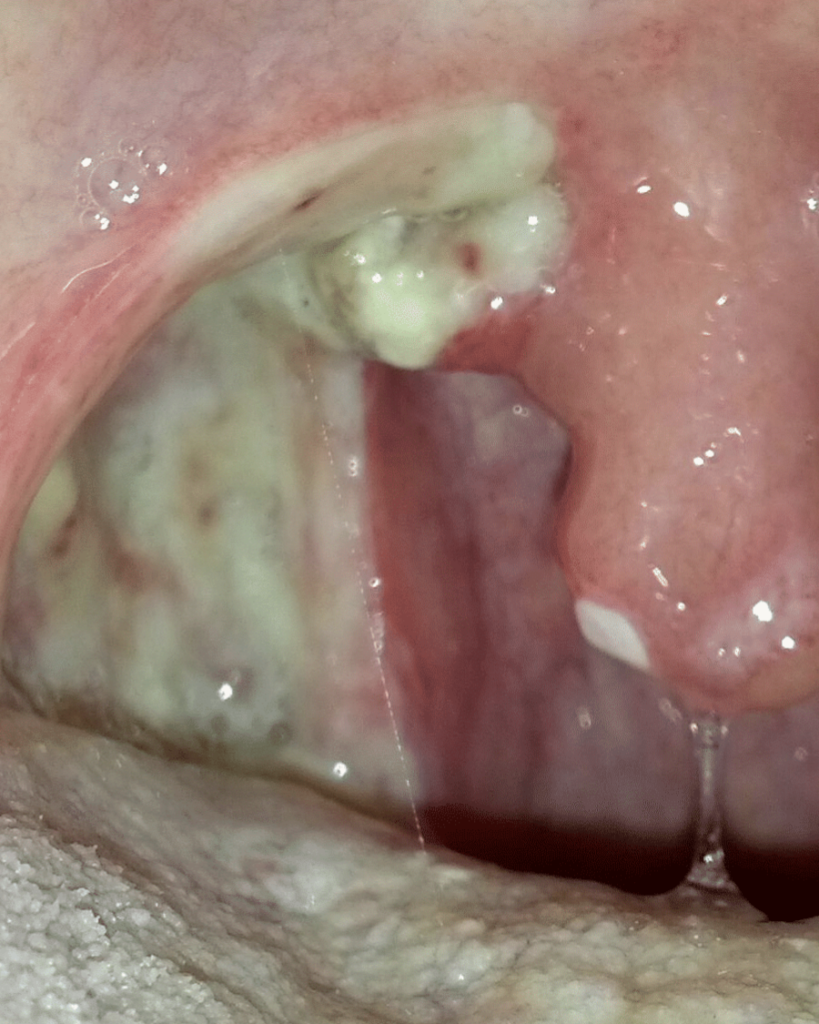 exudative tonsil