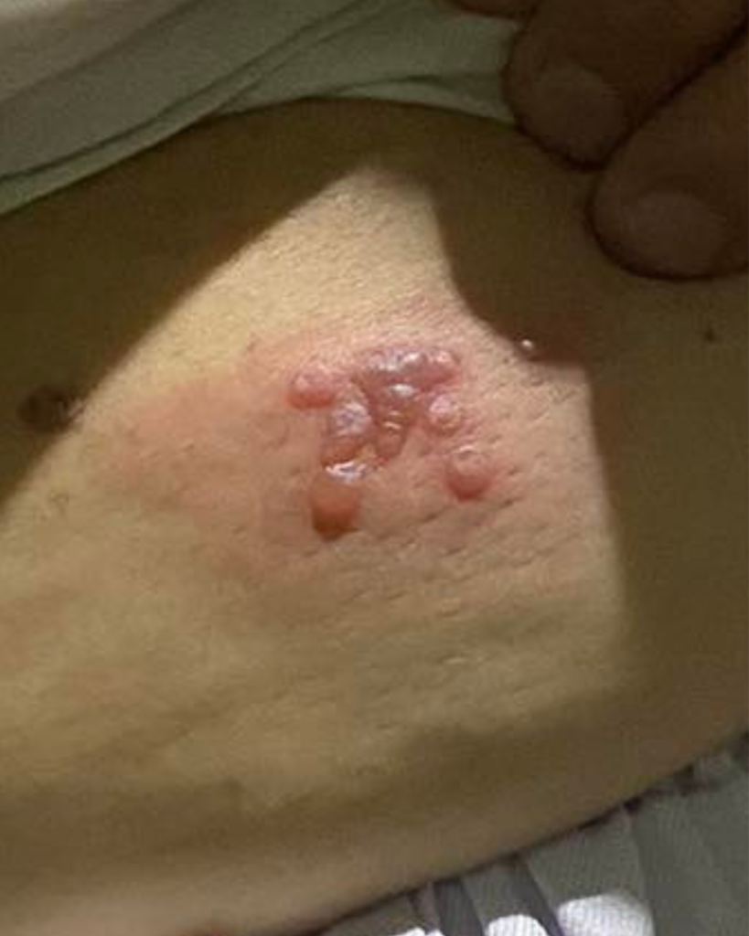 shingles ng nanay ko closer look